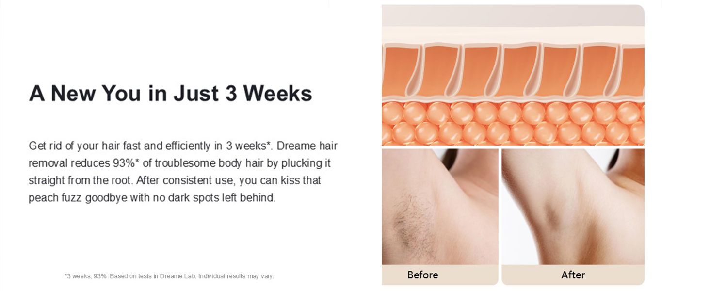 Dreame Hair Removal — 7